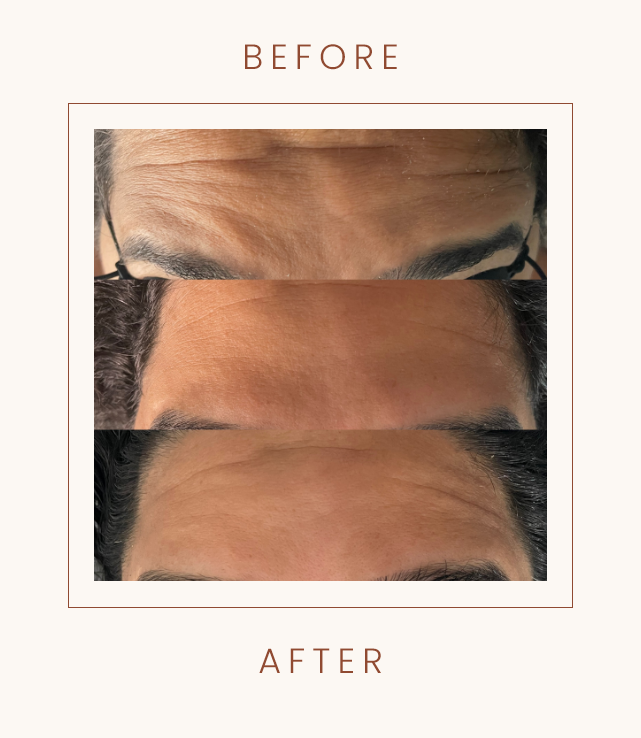 Comparison of foreheads showing results before and after a cosmetic treatment, illustrating reduced wrinkles and smoother skin.