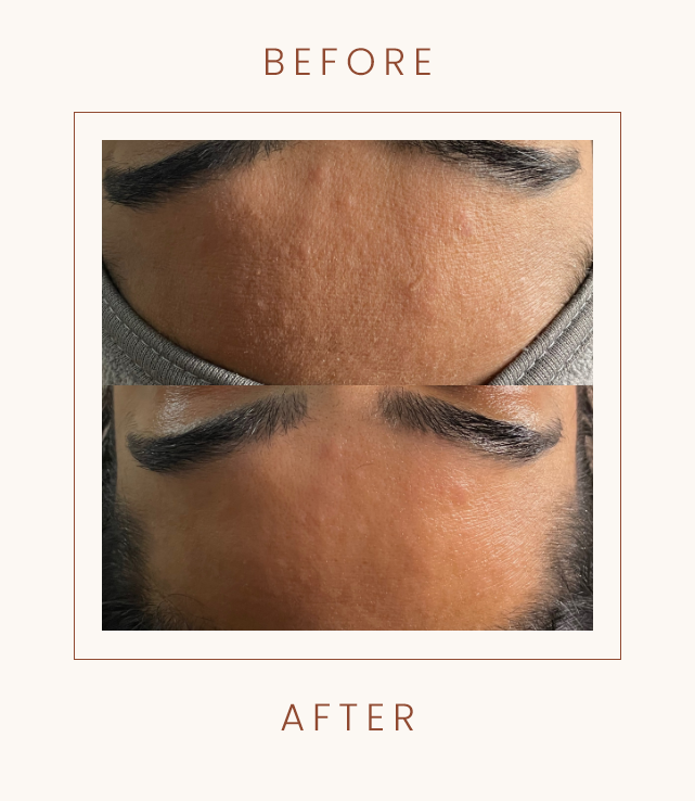 Before and after photo showing forehead skin improvement