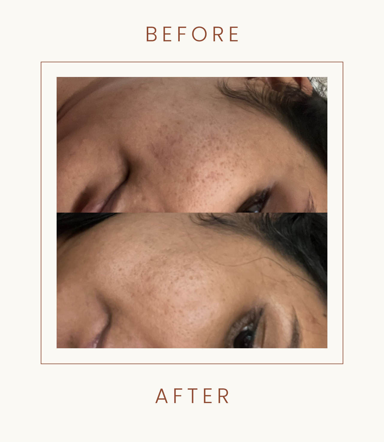 Before and after skincare treatment showing improvement in skin texture and blemishes on a person's face.
