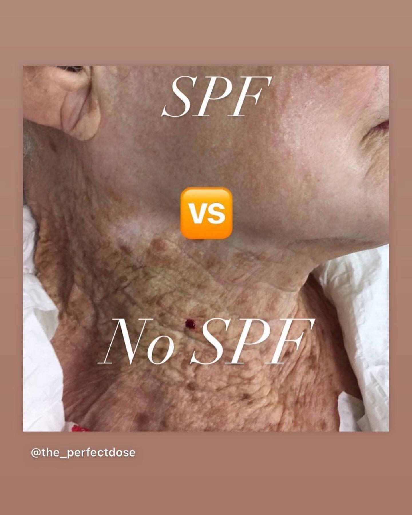 A Picture is worth a thousand words&hellip;wear your sunscreen now and invest in quality skincare and treatments🫶🏼#spfdailykeepswrinklesaway #beautybabe#glowup #simplyskin #eminenceorganics #masteresthetician #agelater✨ #brightonskincare #spa #mich