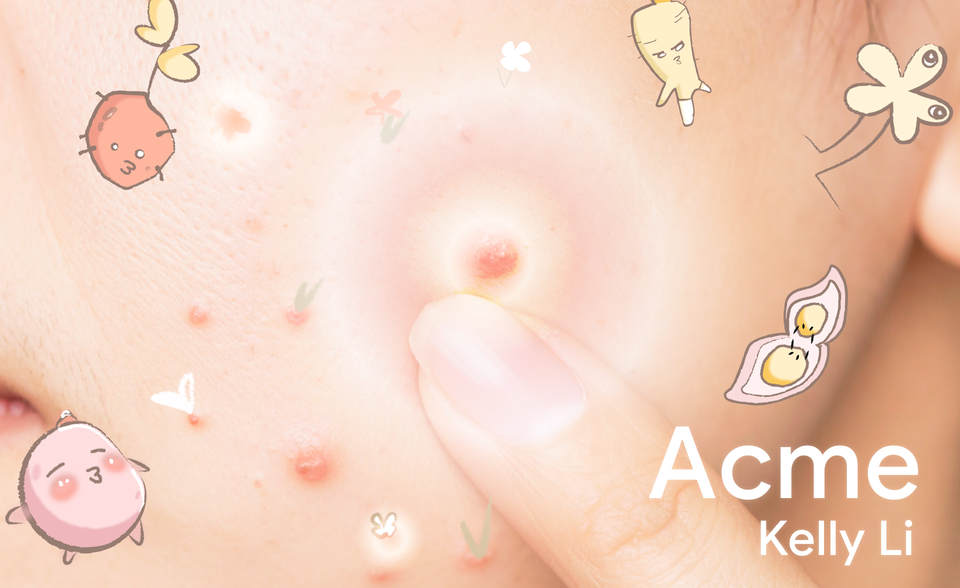 Kelly Li | Pimple it Up!