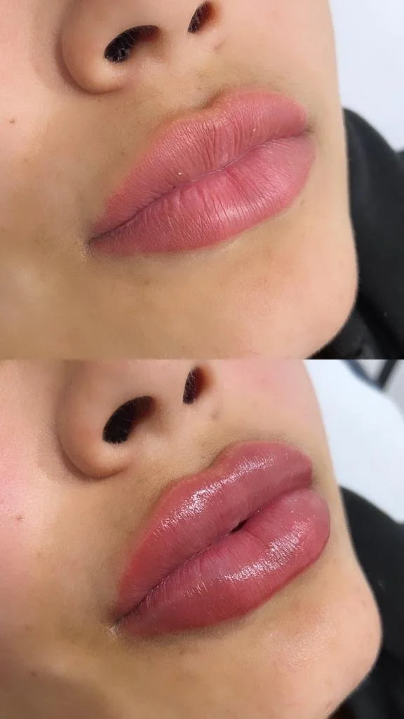 Preenchimento Labial.jpg