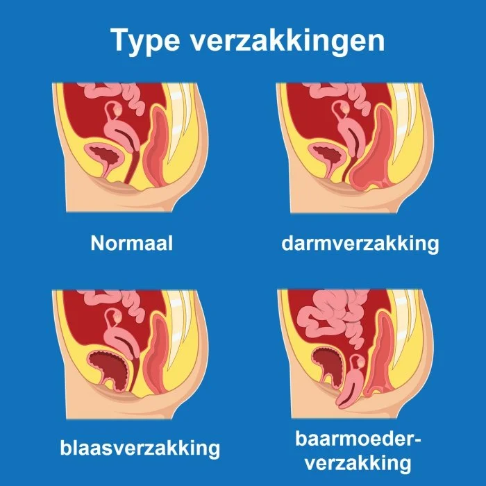 Verzakking en prolaps