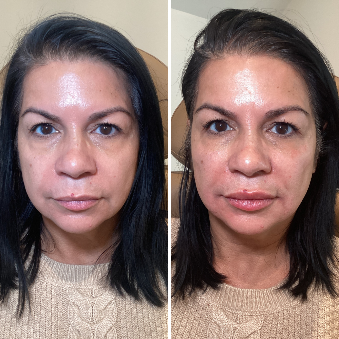 Full Facial Balancing