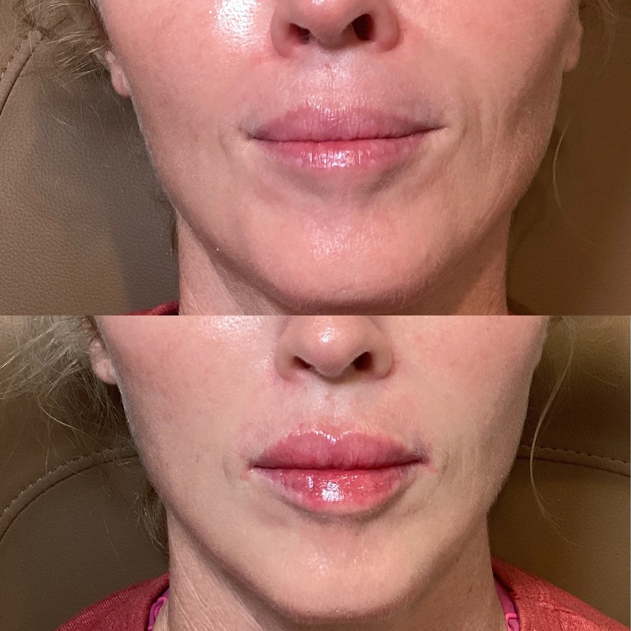 Lip Filler
