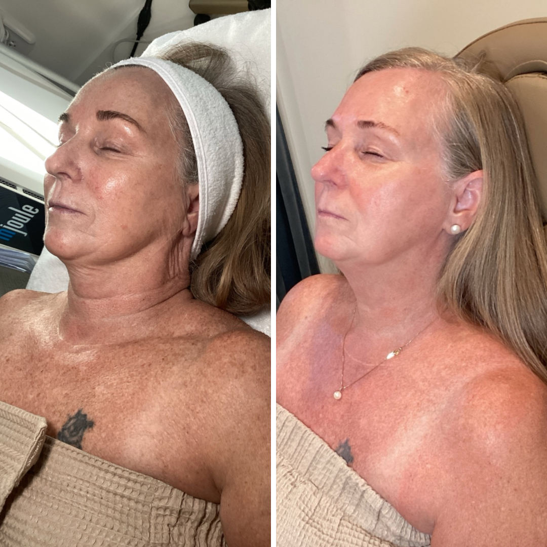 Moxi/BBL Stacked Face, Neck & Chest Single Treatment 
