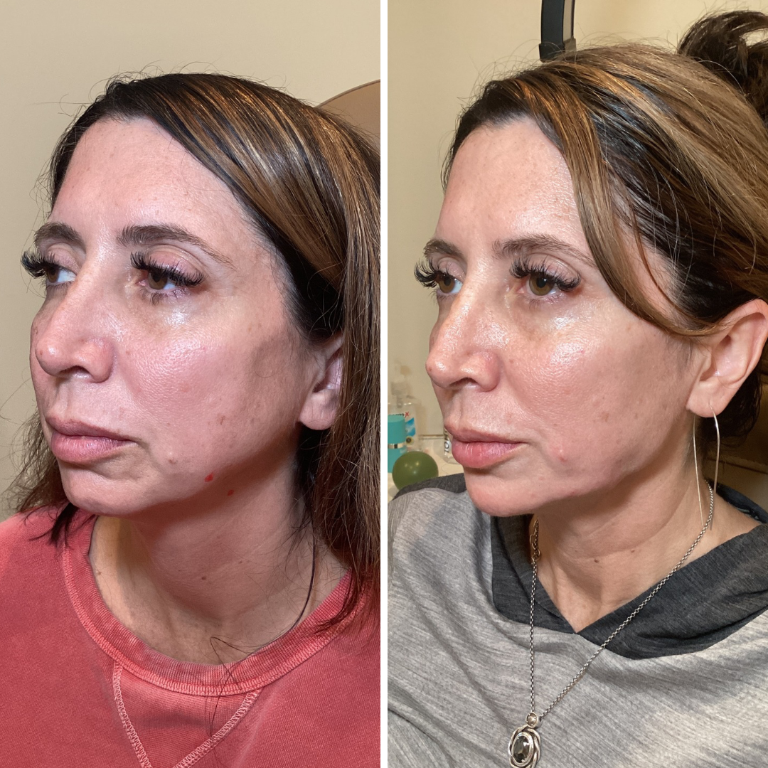 Full Facial Balancing 