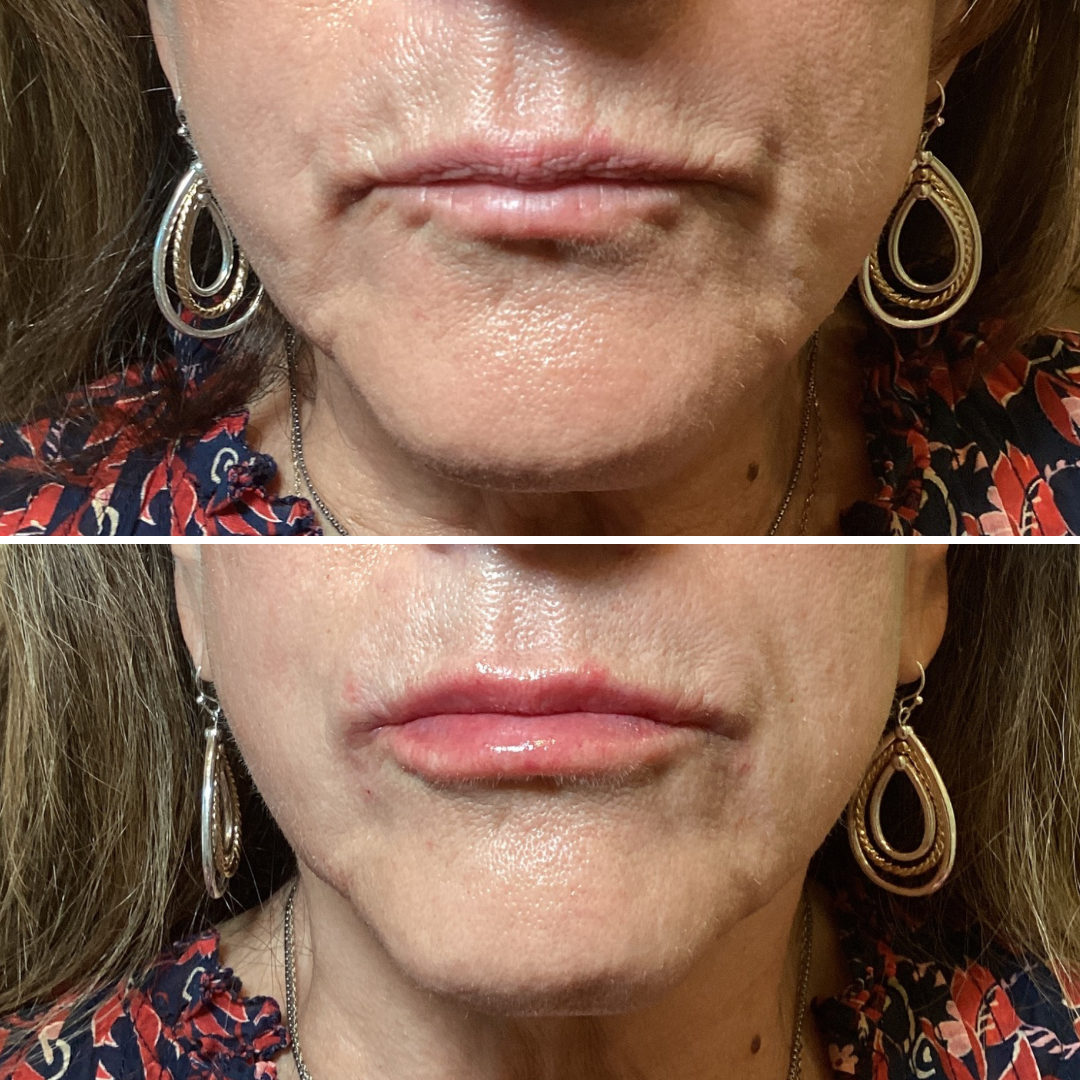 Lip Filler
