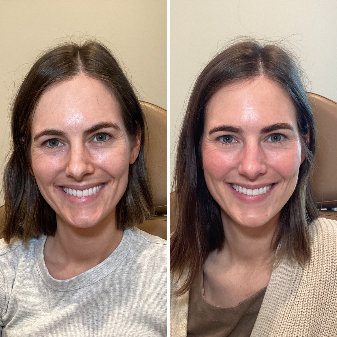 Upper Face + Crow's Feet 
