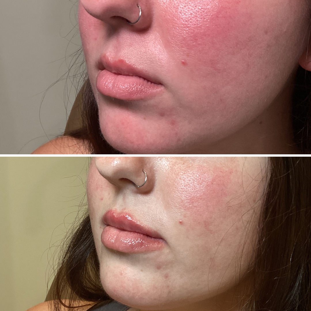 Lip Filler