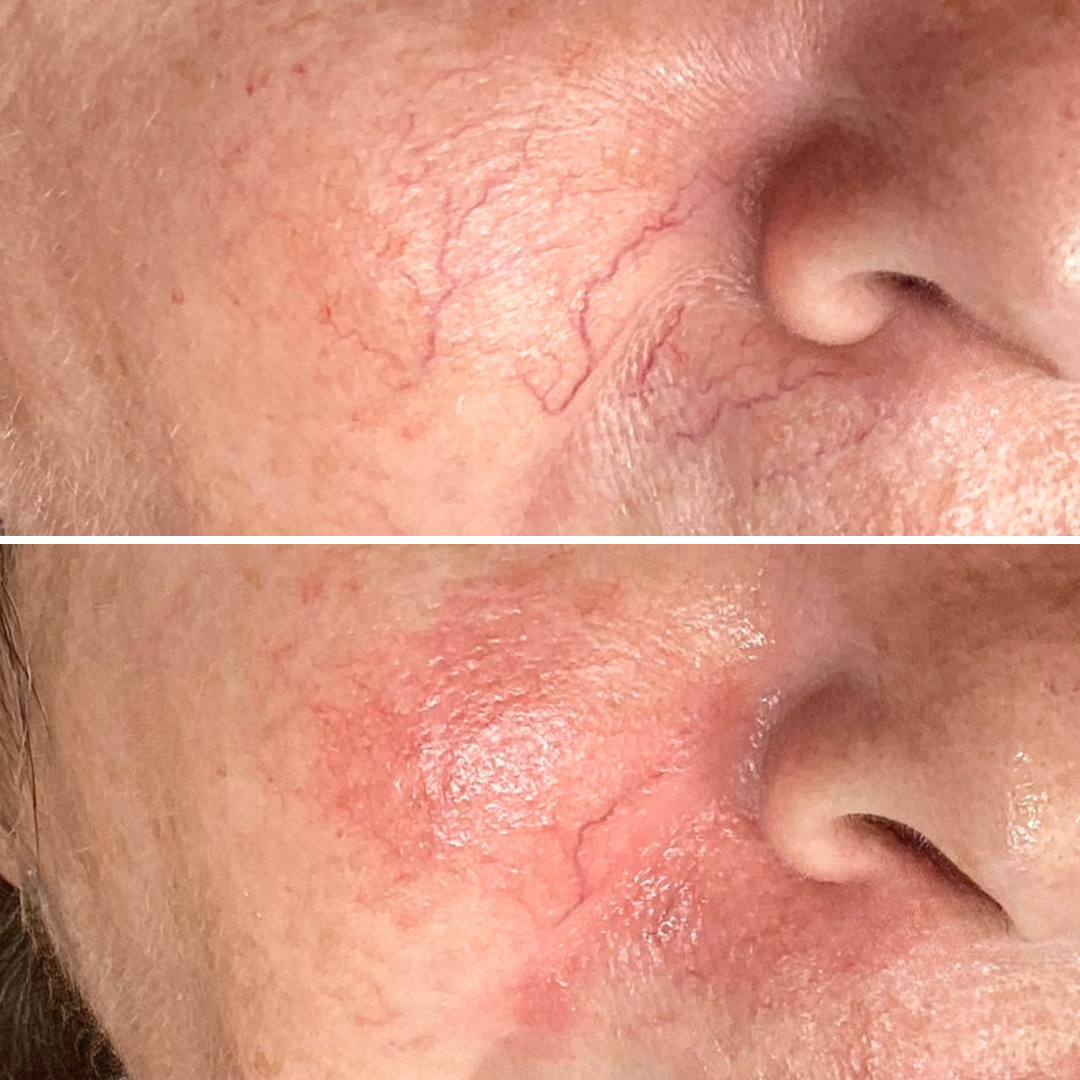 BBL Vascular Spot Single Treatment
