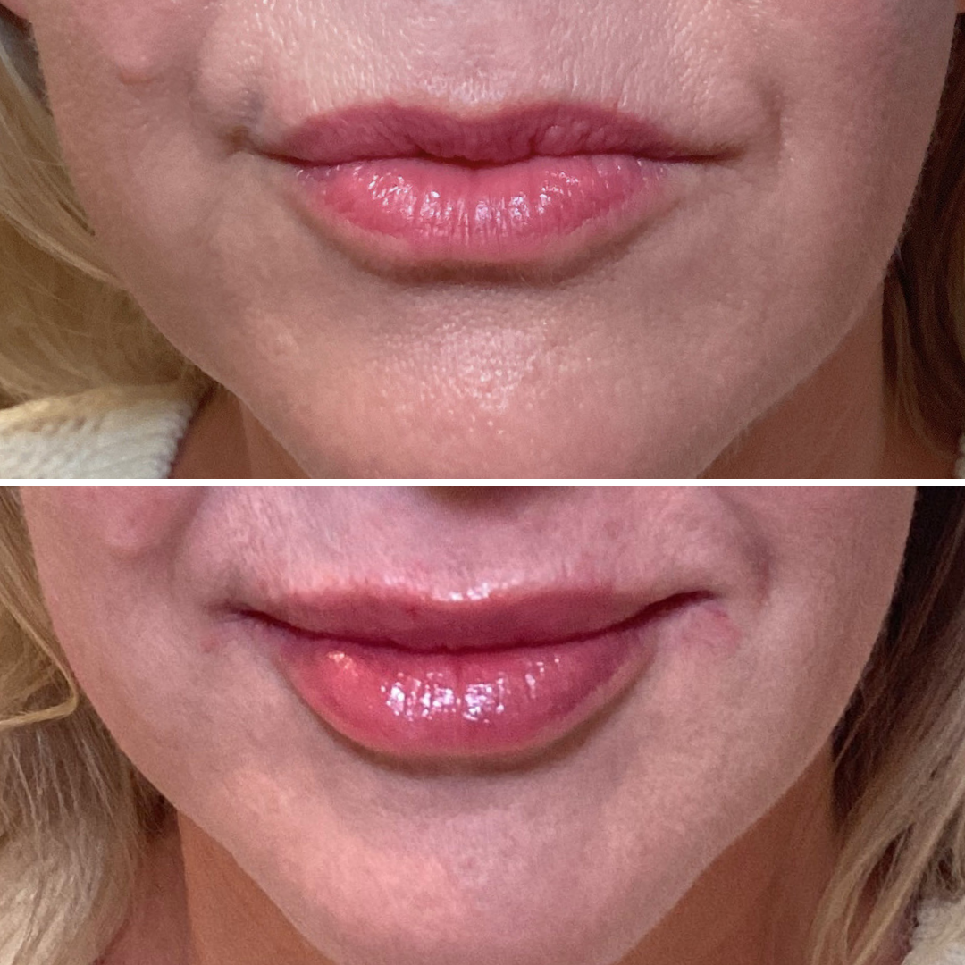 Lip Filler