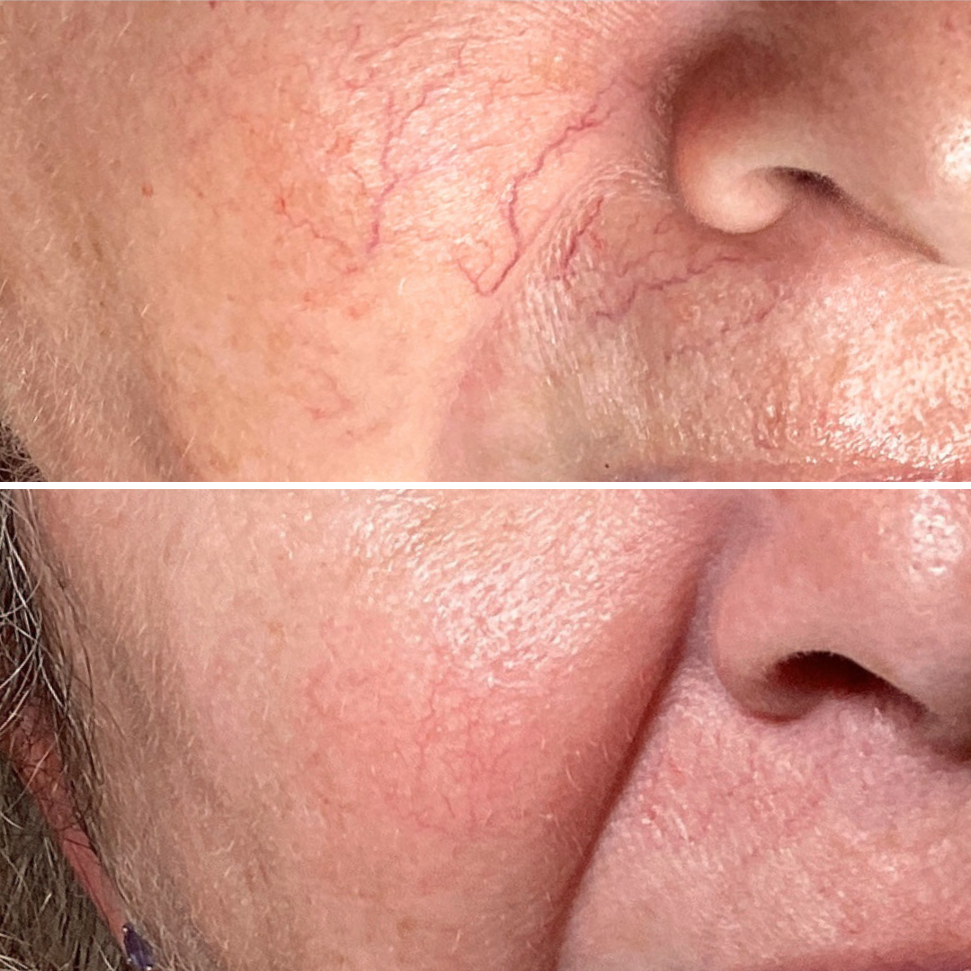BBL Vascular Spot (2 Treatments)