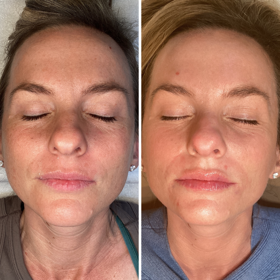 Moxi/BBL Stacked Face + Neck Single Treatment