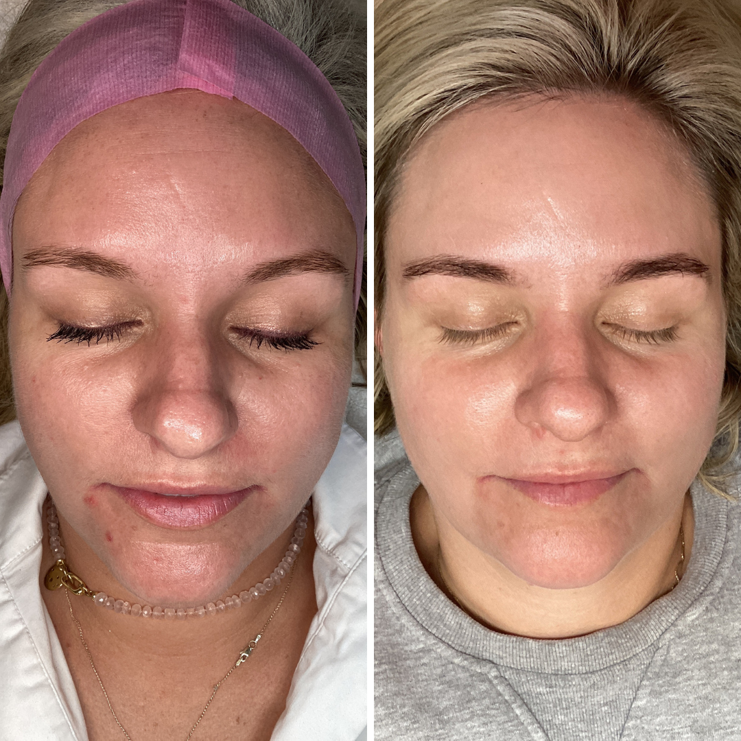 Moxi/BBL Stacked Face Only Single Treatment 