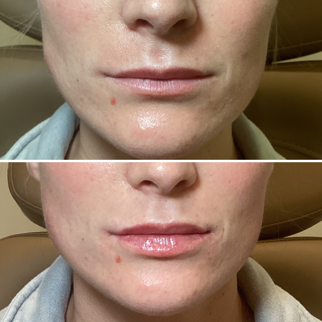 Lip Filler