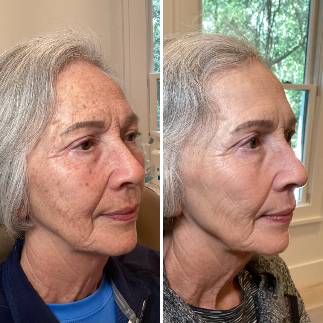 Moxi/BBL Stacked Face Only 3 Treatments Series 