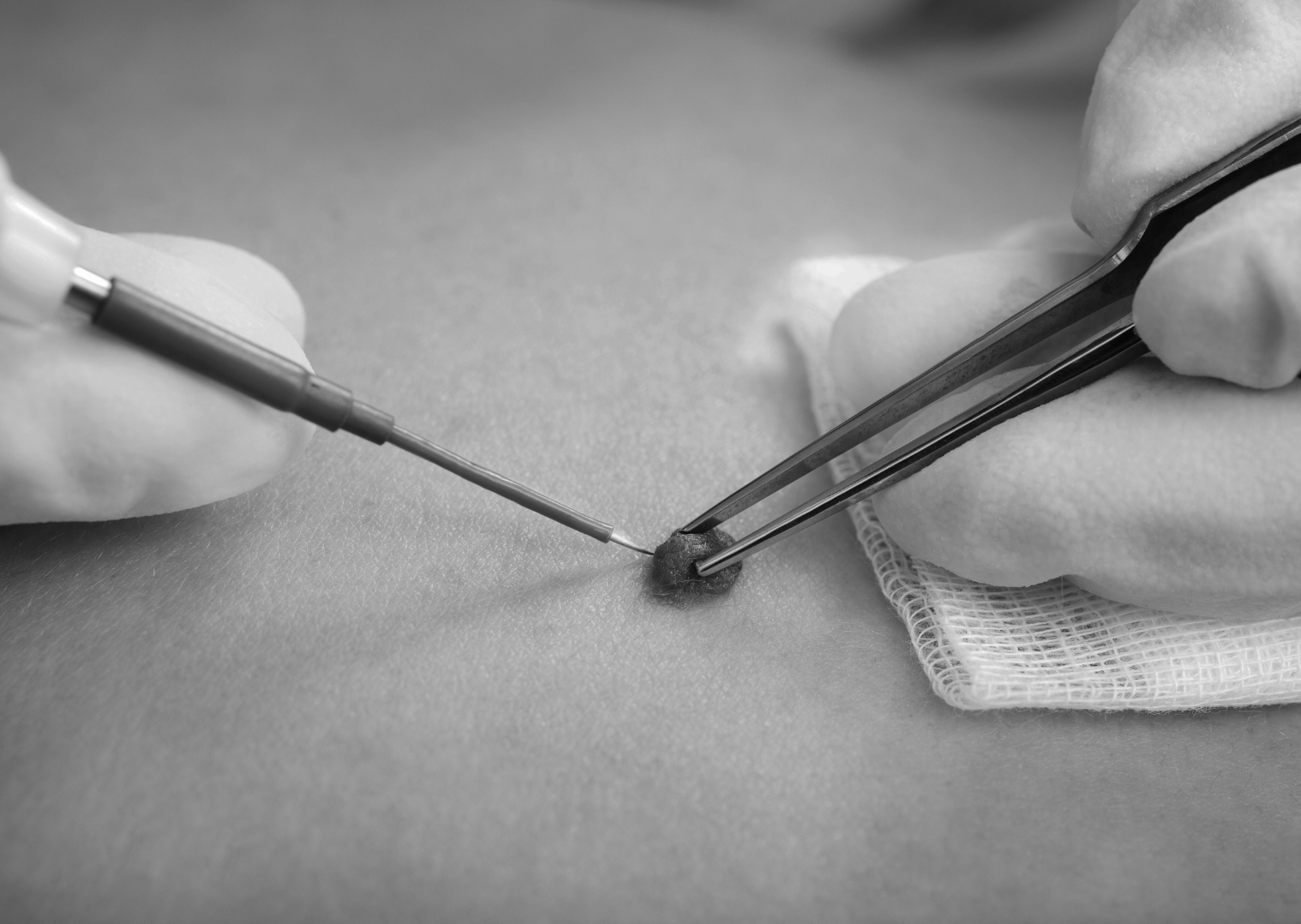 Why Anal Skin Tags Are More Common Than You Think