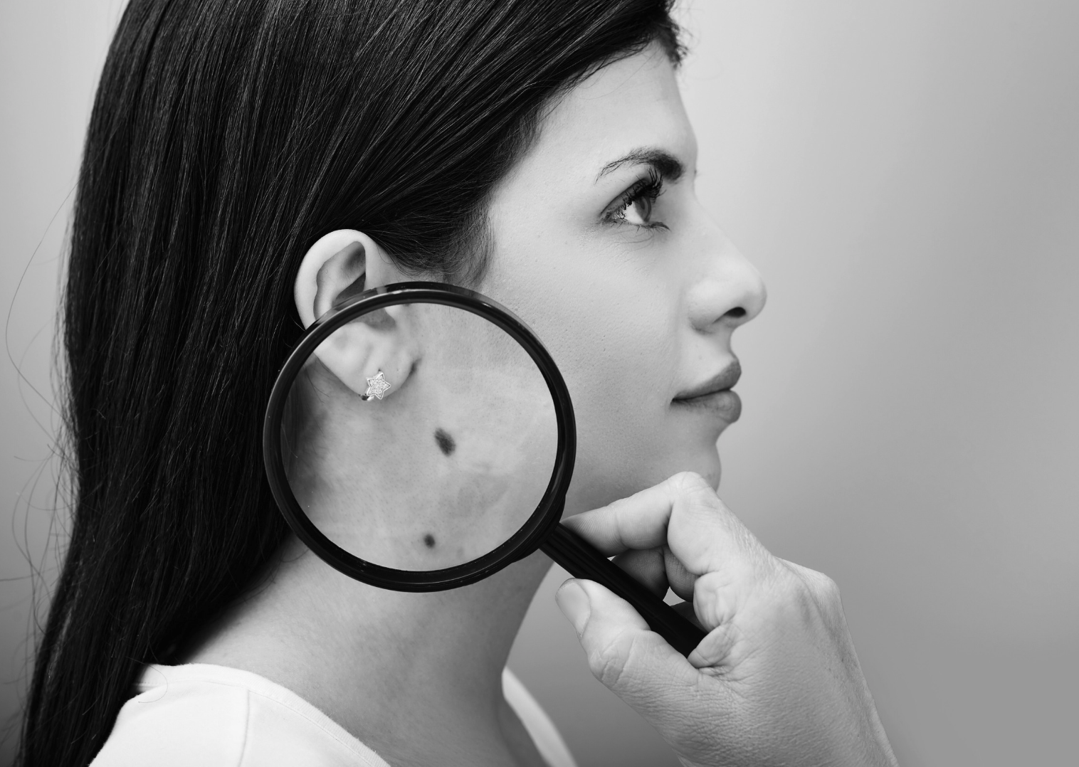 Cosmetic Mole Removal Explained: The Ellman Surgitron Approach