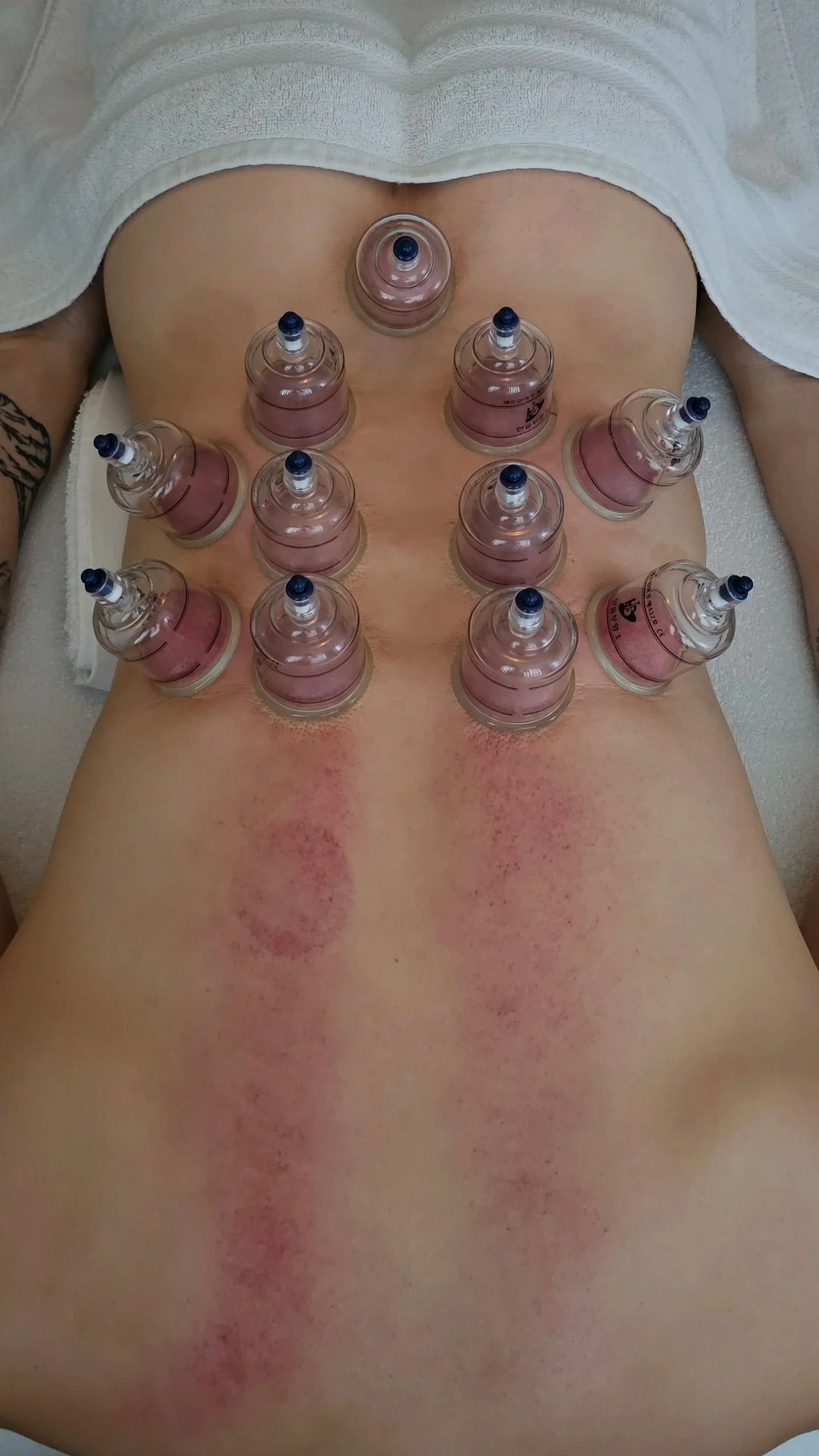 Person receiving cupping therapy on their back with several suction cups placed on the skin, lying on a white towel.