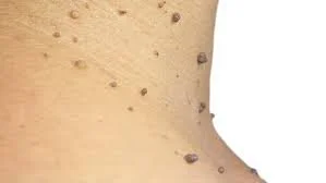 skin tags.jpg