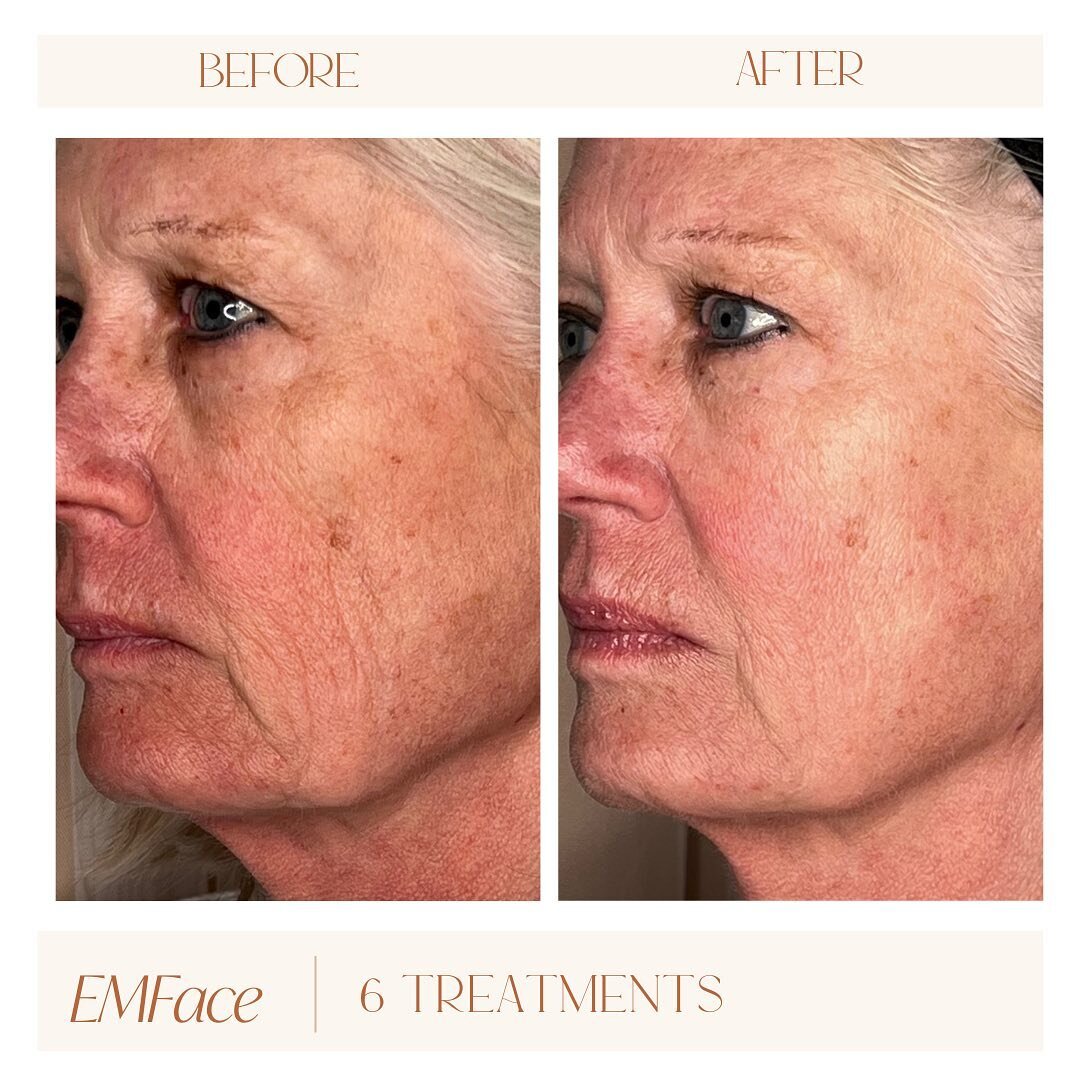 🪄 It&rsquo;s not Magic, It&rsquo;s EM Face ✨ 

Would you believe me if I told you these results weren&rsquo;t even her peak treatment results?! That happens at 12 weeks POST treatment!

 How about if I told you this was achieved with: 
🚫NO downtime