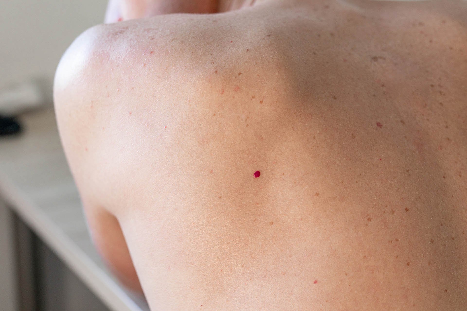 Blemish Removal at SKINLAB, Deal, Kent