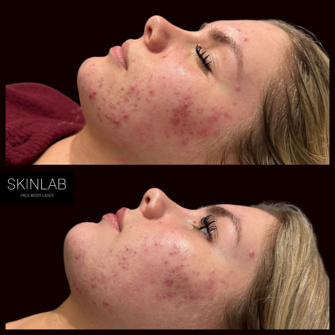 [NeoGen plasma treatment] results