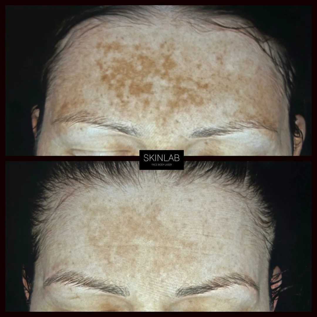 Let’s talk about [pigmentation]