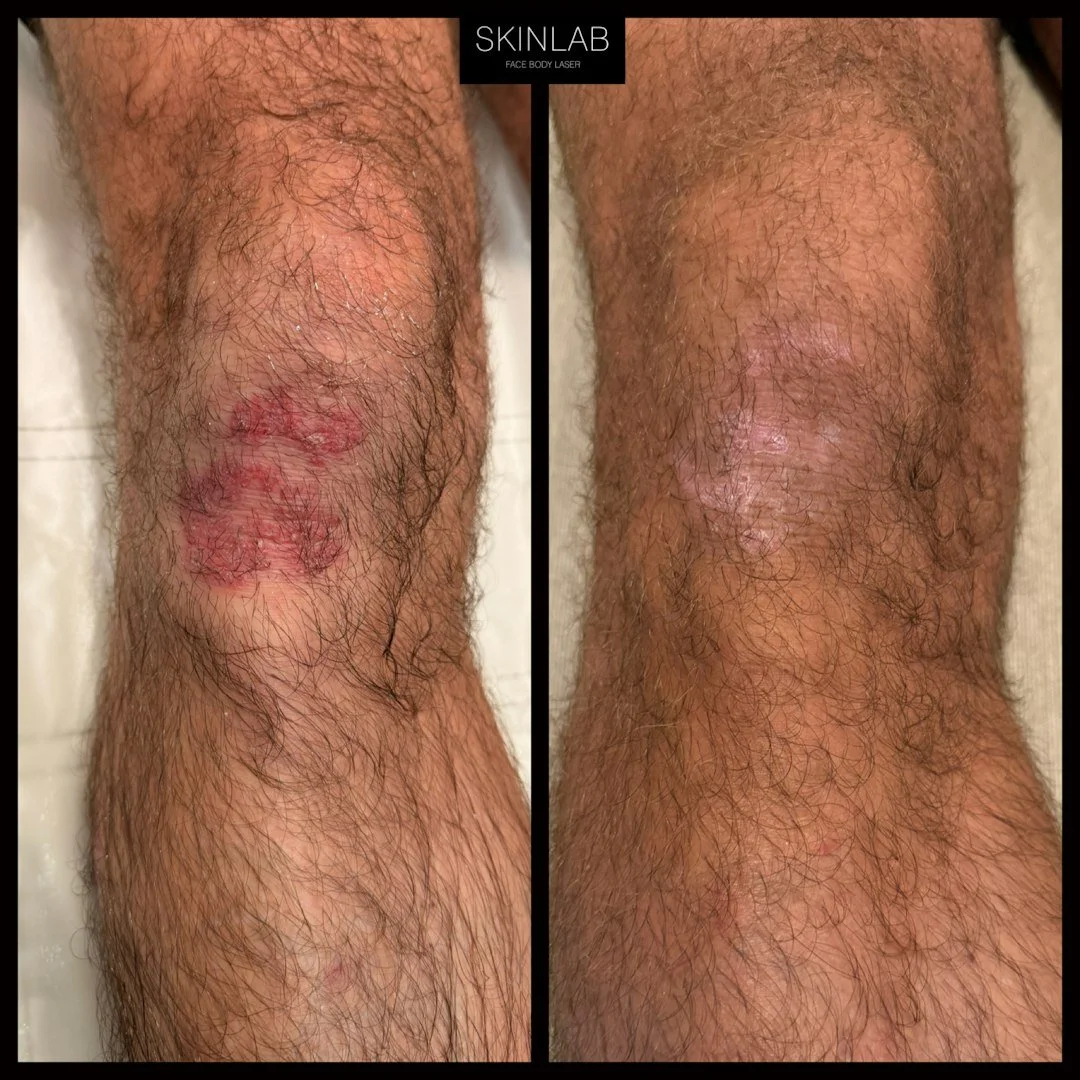 [Neogen Plasma] Before &amp; After Pictures