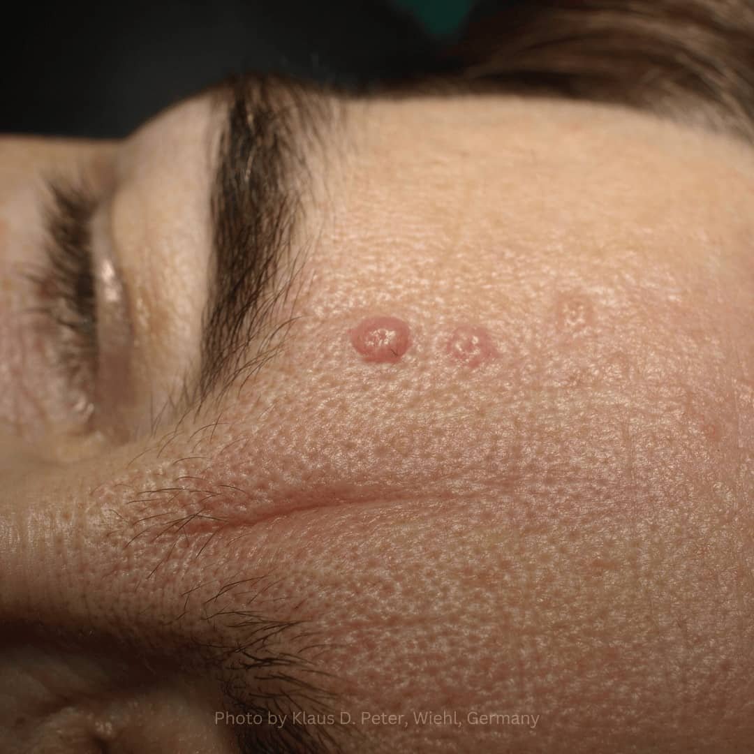 Sebaceous+Hyperplasia+(1).jpeg