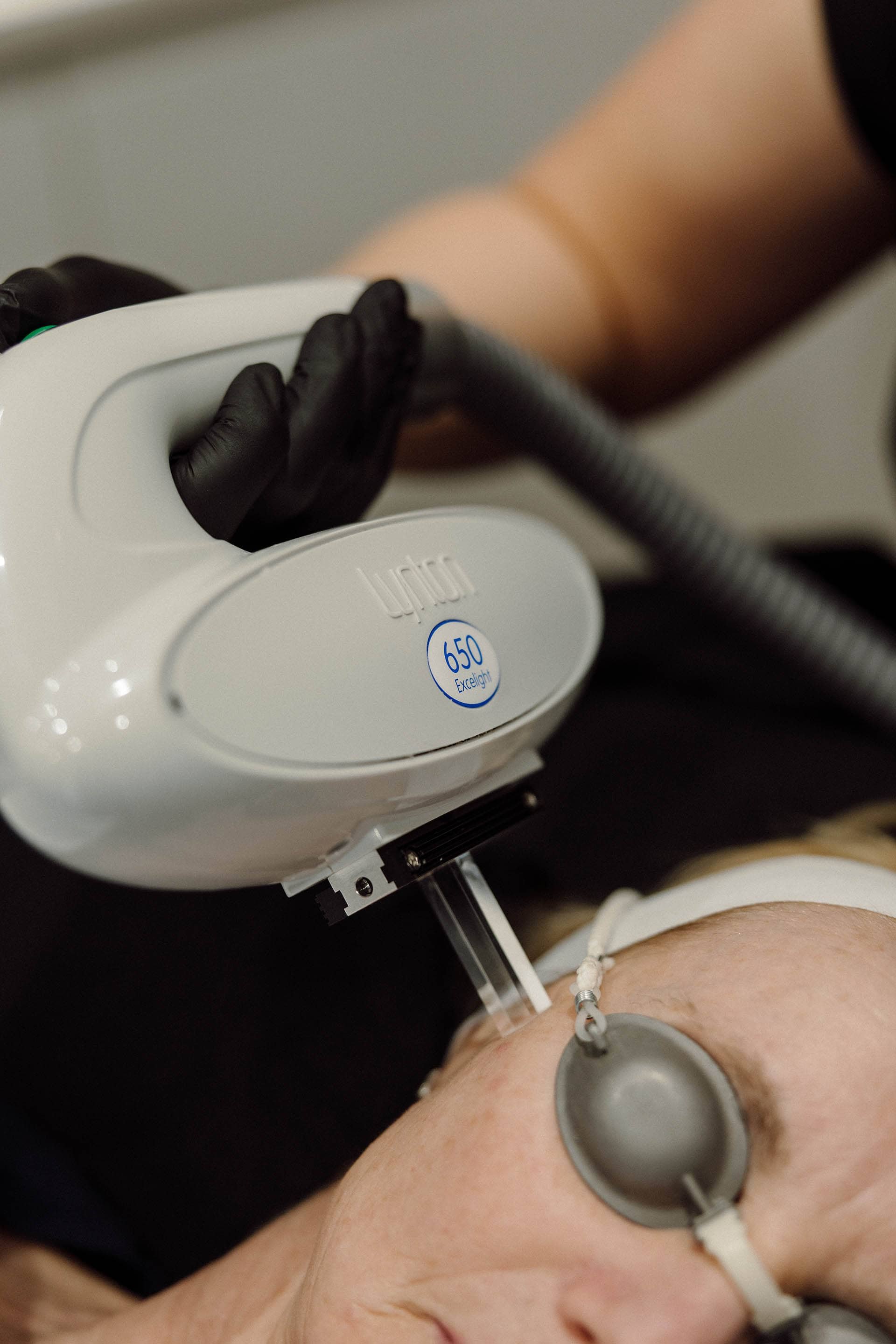 IPL Laser Facial called illumiFacial at SKINLAB, Deal, Kent