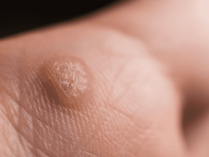 Wart & Verruca Removal at SKINLAB, Deal Kent | Blemish Removal