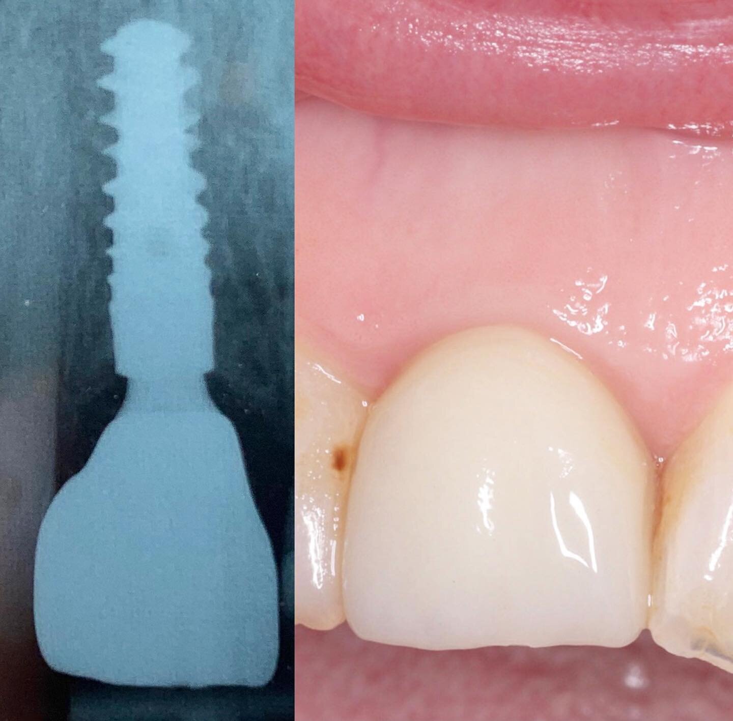 @straumannuk BLX @ 1 year review.

💉 Flapless Immediate placement and jump gap augmentation with @ethossregeneration following extraction of a retained root.