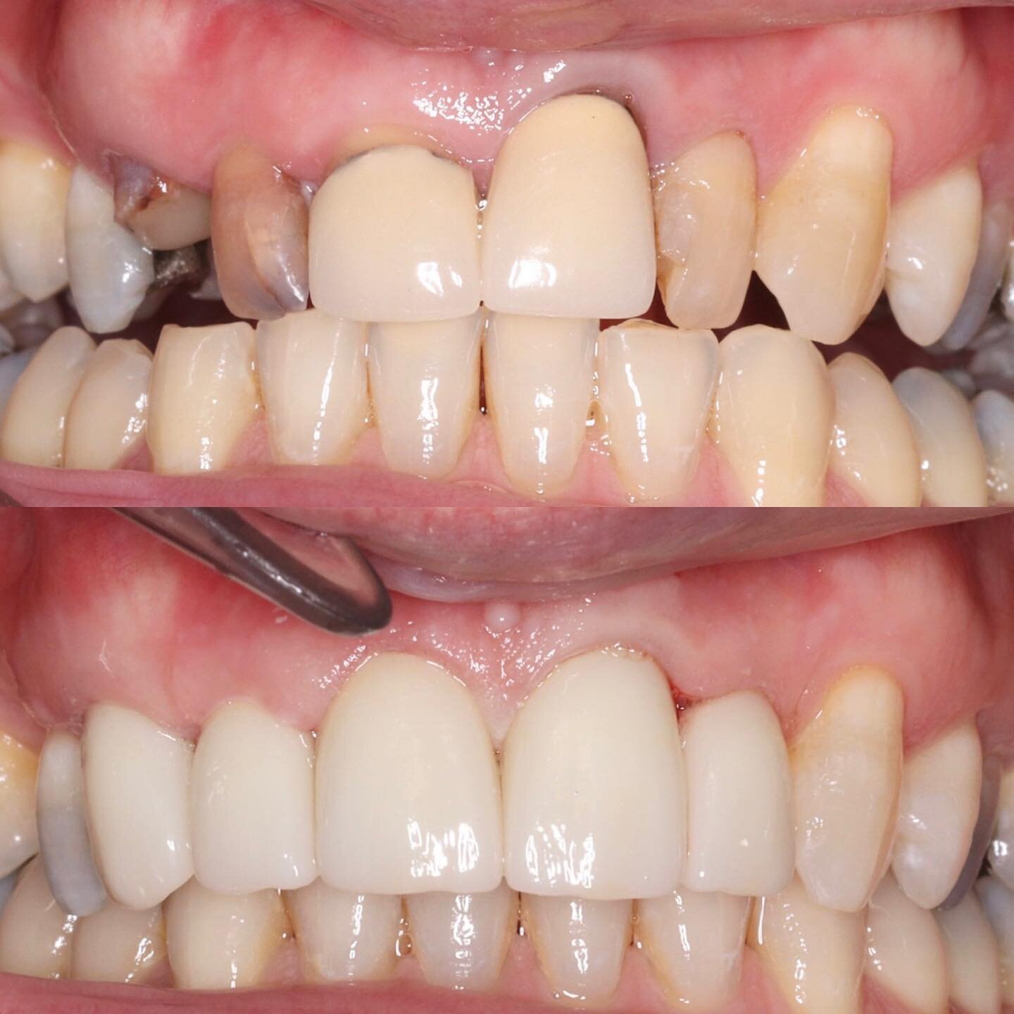 Super satisfying case to complete for both the patient and us after a number of months of treatment included crown lengthening, direct fibre post-crown and whitening before new ceramics 😁