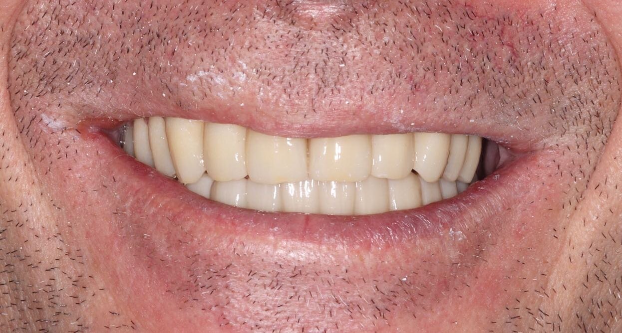 🕓 18 months later final fit of full upper and lower implant retained bridges 

Patient went AWOL abroad during COVID but the PMMA temporary bridges stood the test of time 💪

&gt; Swipe to see the tissues on the lower and first disconnection - @stra
