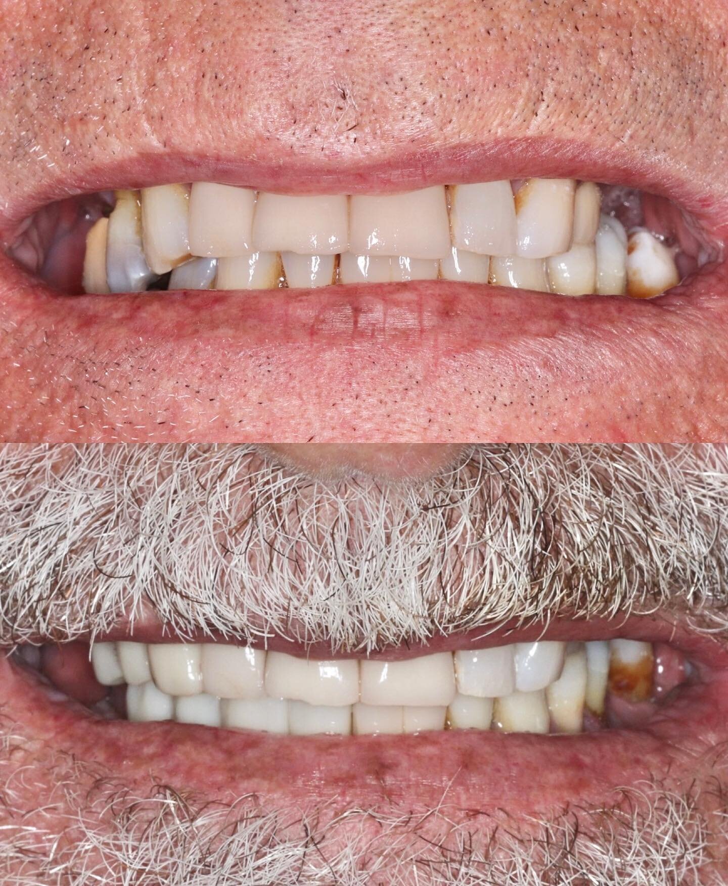 Patient concerned his teeth were &lsquo;drooping&rsquo; on the right. Failing teeth removed and smile line corrected with a tooth-borne bridge ☝️ and implant-borne bridge 👇

Can&rsquo;t take any credit for the beard 😉

Implant: @straumannuk 
Cerami