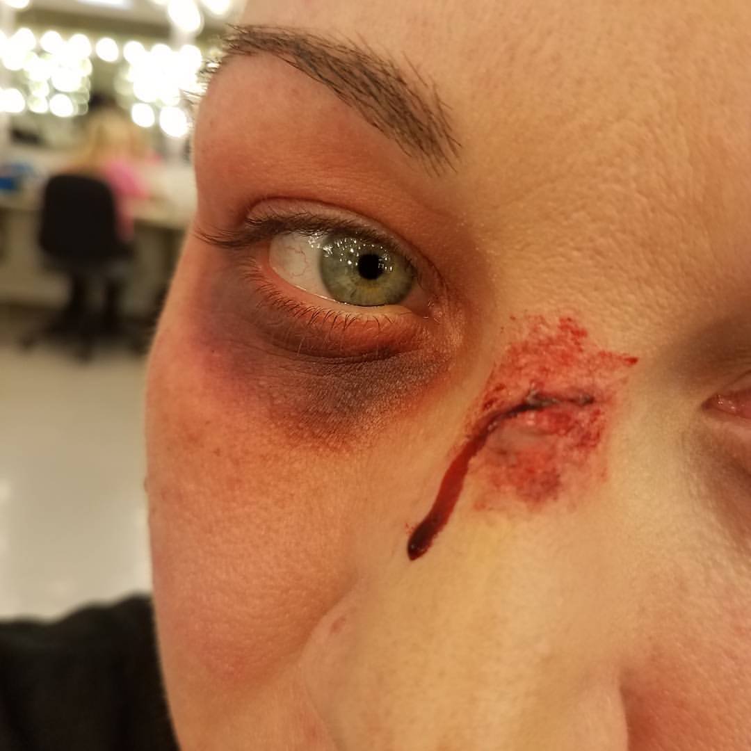 Bruised eye and split nose.