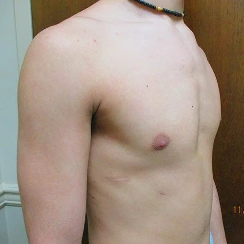 Galleries — The Center of Excellence for Pectus
