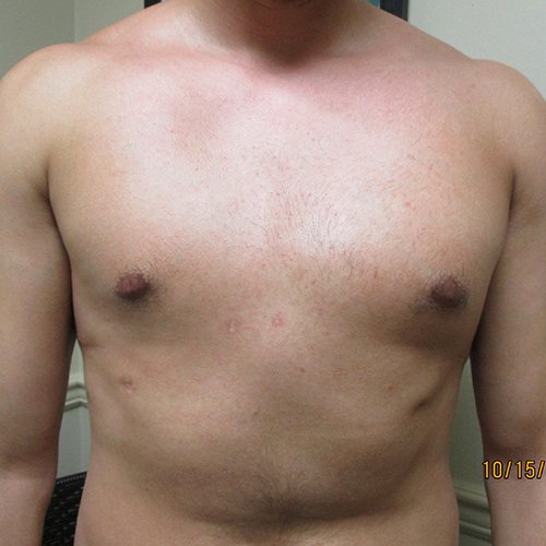 Galleries — The Center of Excellence for Pectus