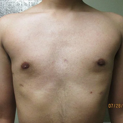 Galleries — The Center of Excellence for Pectus