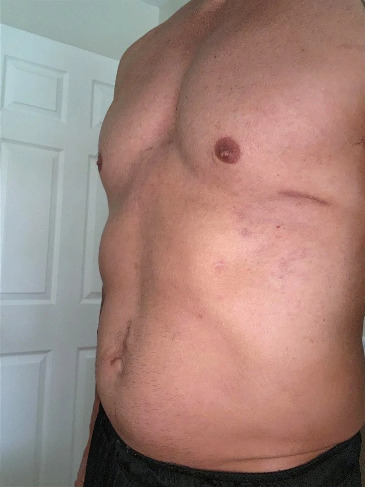 Michael V. – Dr. LoSasso's Oldest Nuss Patient Shares His Experience