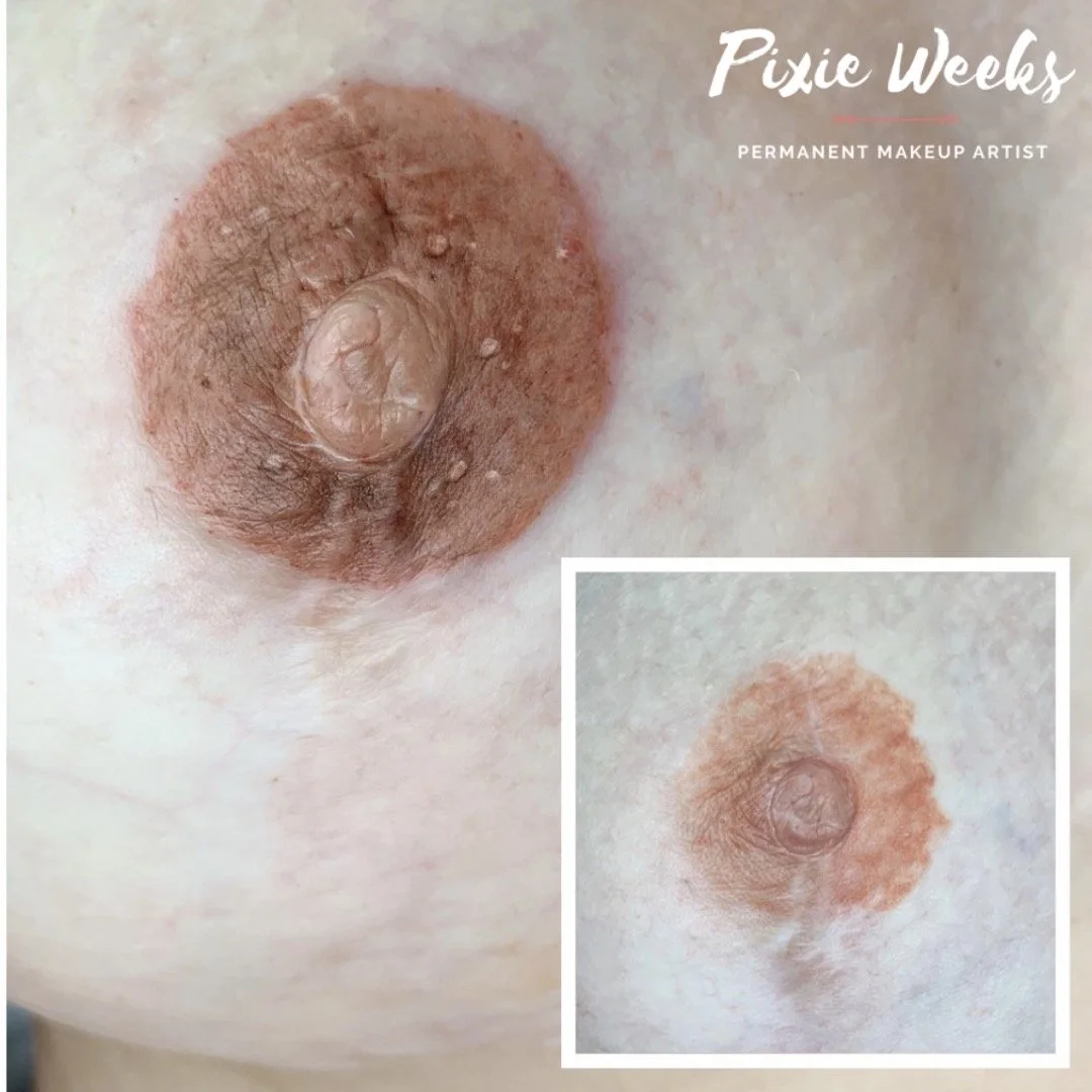 Pixie Areola Correction .jpg