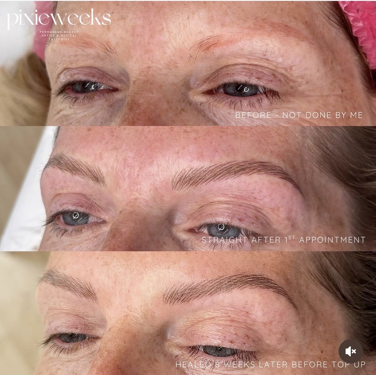 Combination Brow Rework - Healed