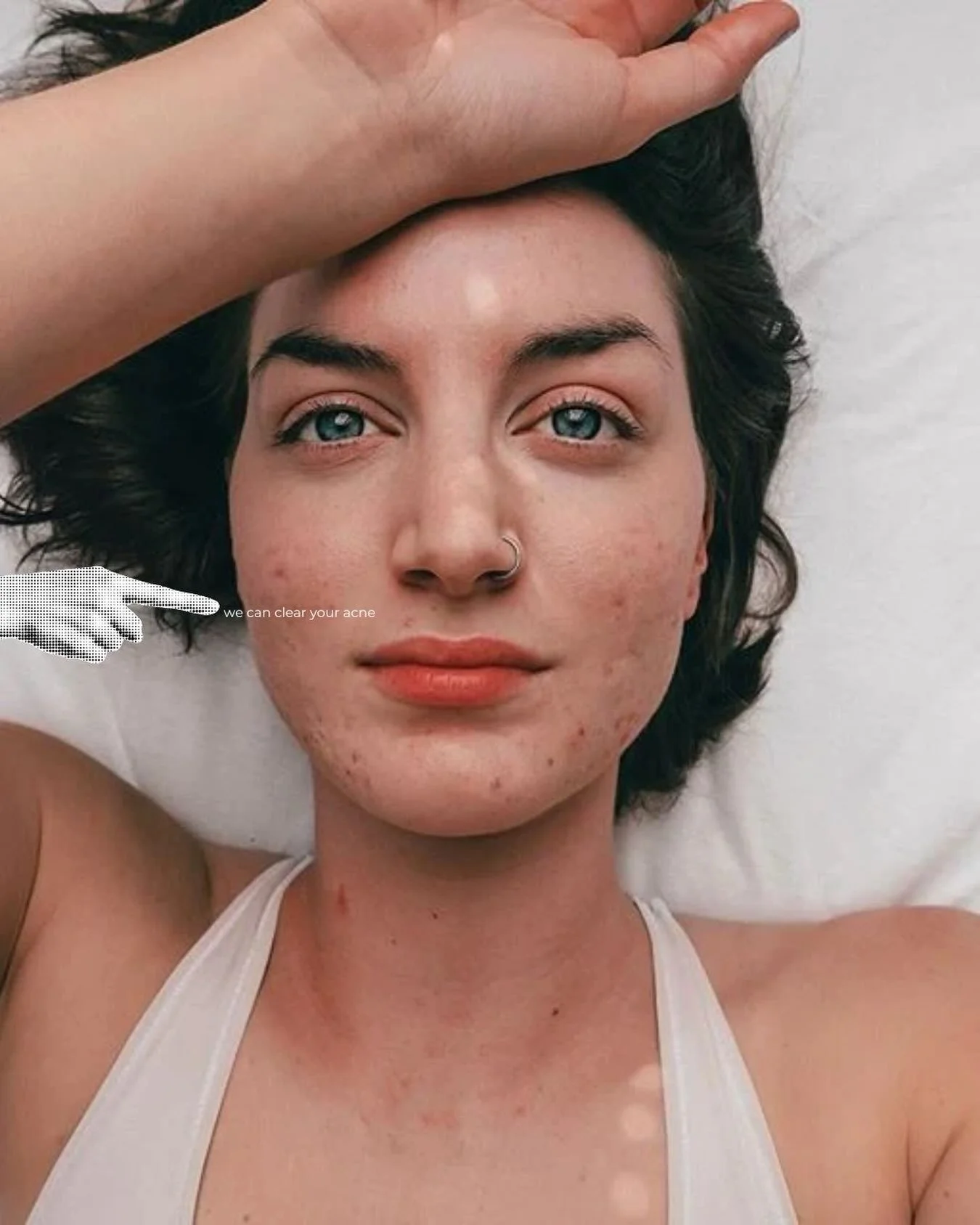 You&rsquo;ve tried products. Maybe treatments. Maybe you&rsquo;ve changed your routine more times than you can count.

And you're still breaking out.

This is where we start.

We don't just look at the acne &mdash; we look at your skin as a whole.

W