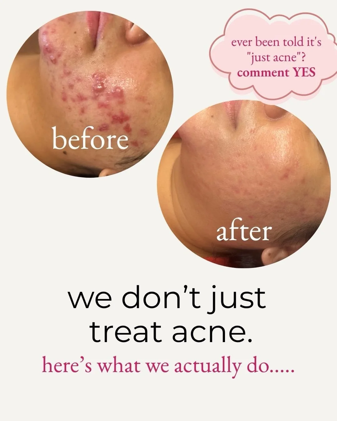 This wasn't just acne, so we didn't treat it like it was.

Breakouts are often a sign of what's going on inside your body as well as on your skin. For this client, we built a plan that covered both:

✨ Inside: gut health, hormonal balance, inflammati