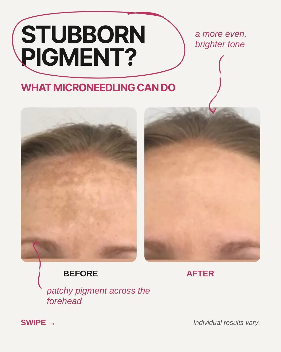 Stubborn pigment that keeps coming back? It might be melasma.

Melasma shows up as brown or grey-brown patches, usually on the cheeks, forehead, upper lip or chin. 

Sun, heat and hormonal shifts (pregnancy, birth control) are common triggers. It&rsq