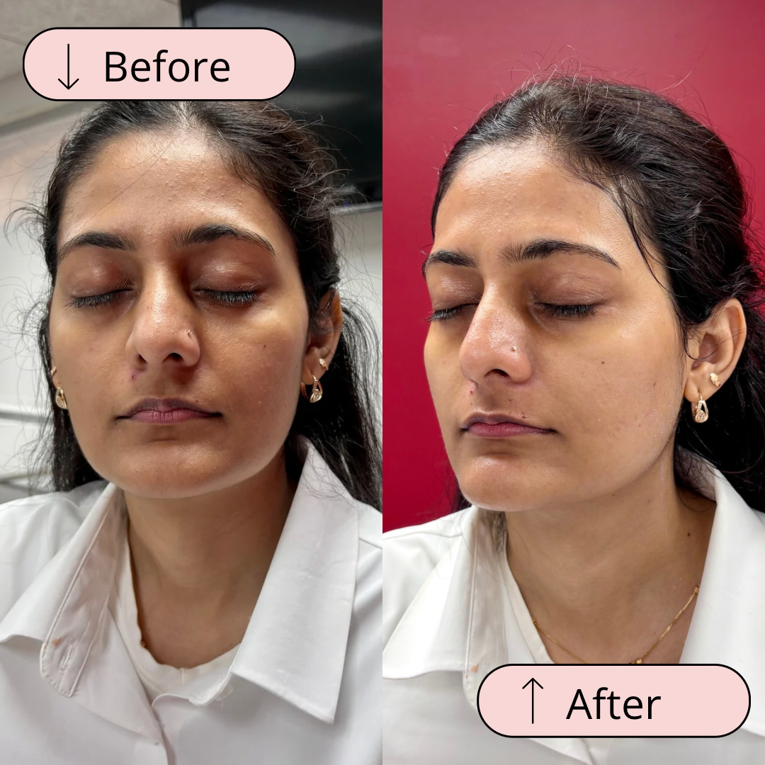 Before and after: improved hydration and reduced redness following a customized facial.
