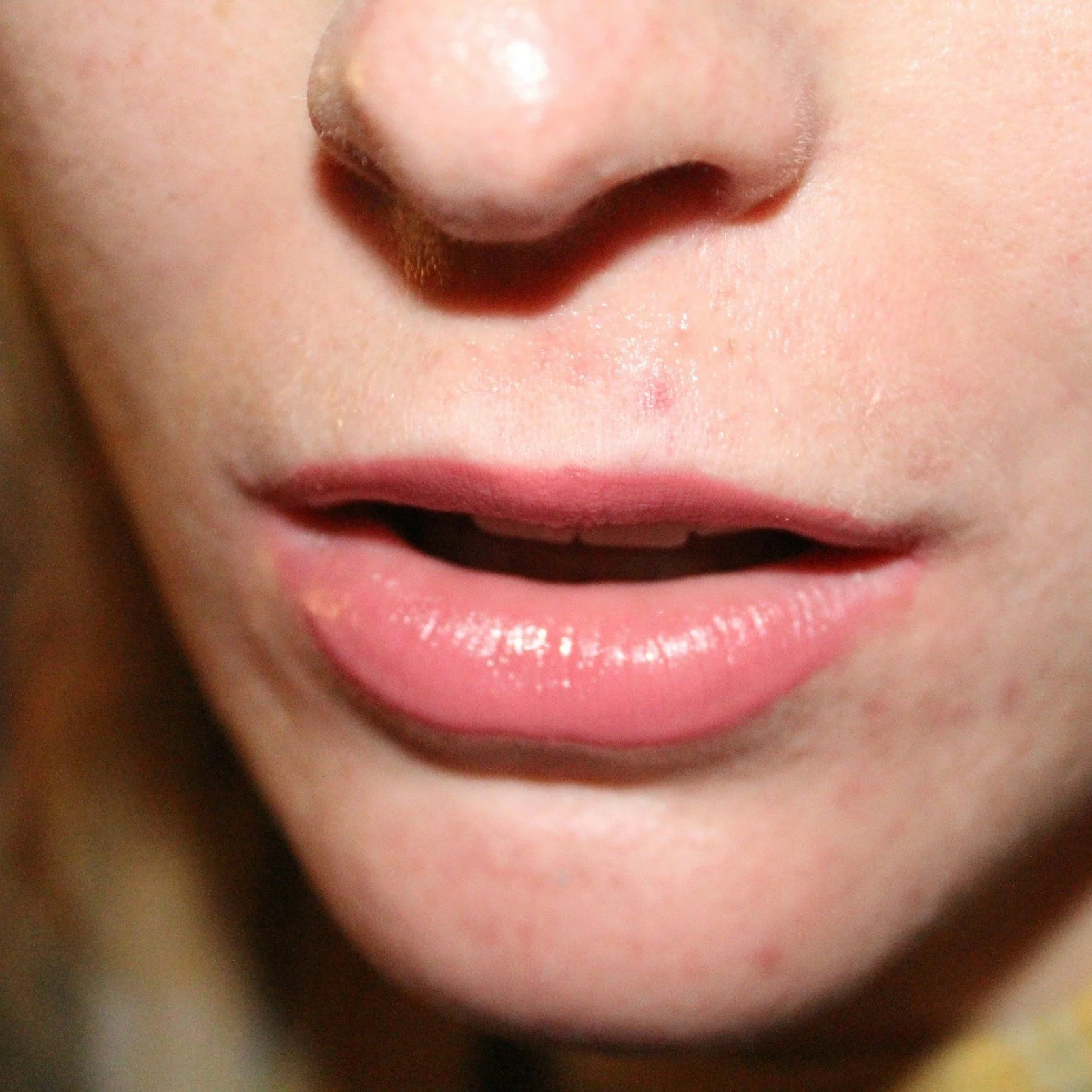 Why Professional Extractions are Better than DIY