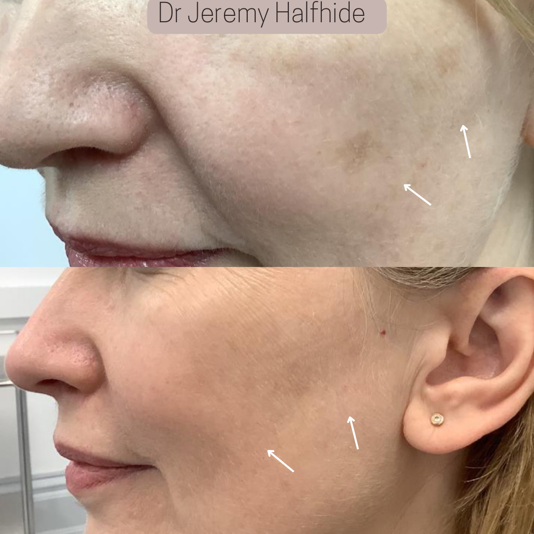 Sun spots improved with just 2 sessions for this patient.